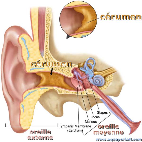 bouchon de cérumen empêchant le bon fonctionnement des intras_auricul