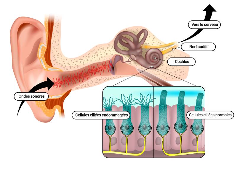 Les effets du bruit sur l'oreille interne.